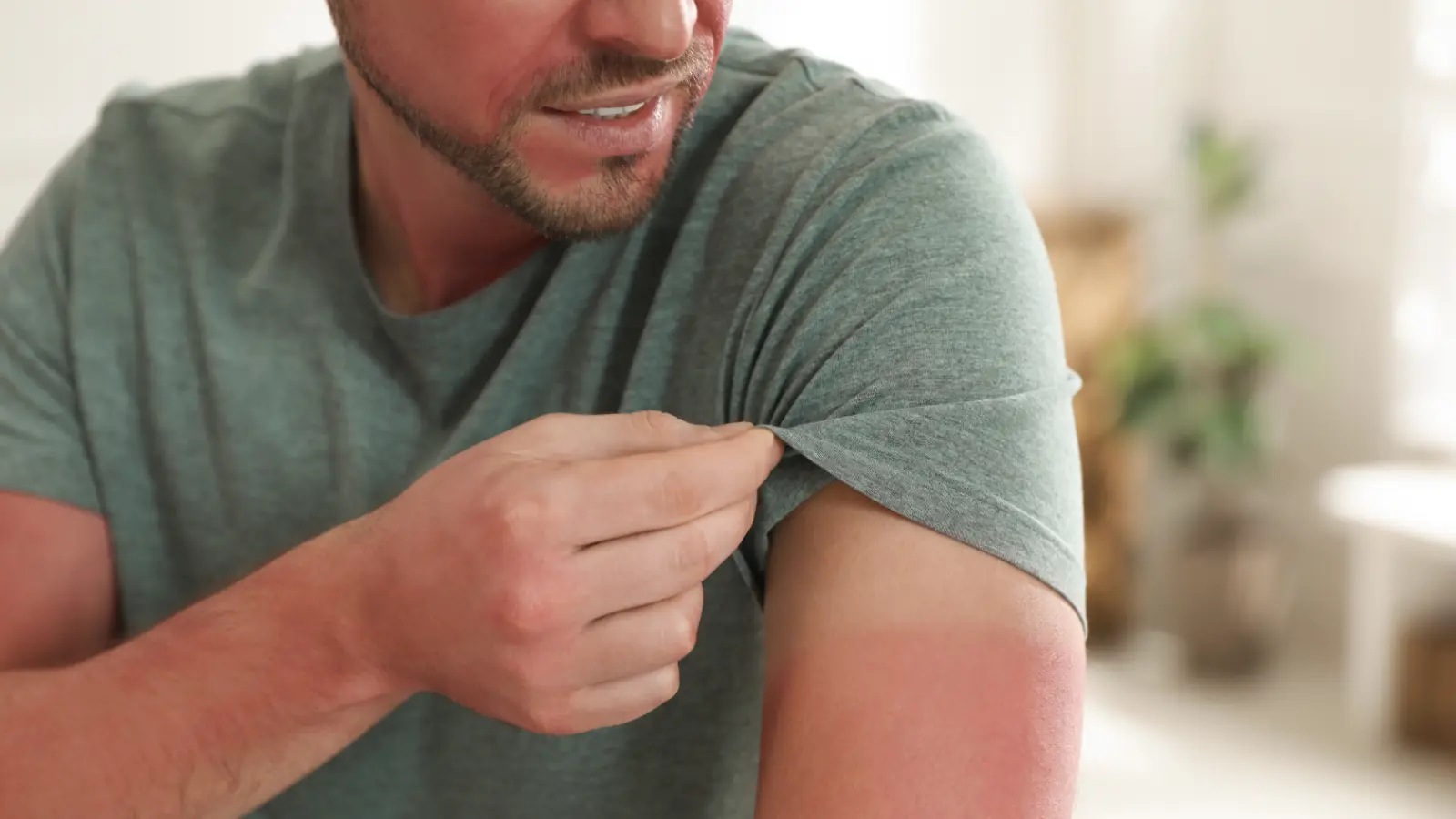 A man with sunburned skin lifting up his shirt sleeve